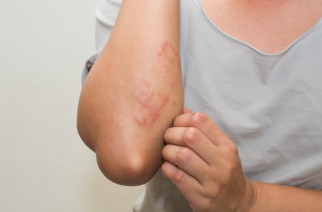 Tratamento eficaz do Eczema nos braços e mãos